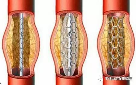 国产支架和进口支架的区别,性能对比与选择指南